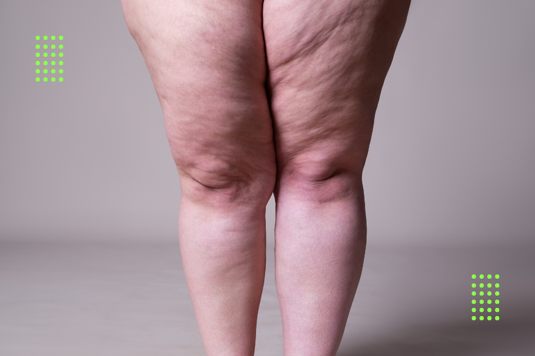 Um papo sobre lipedema e como a alimentação ajuda no tratamento