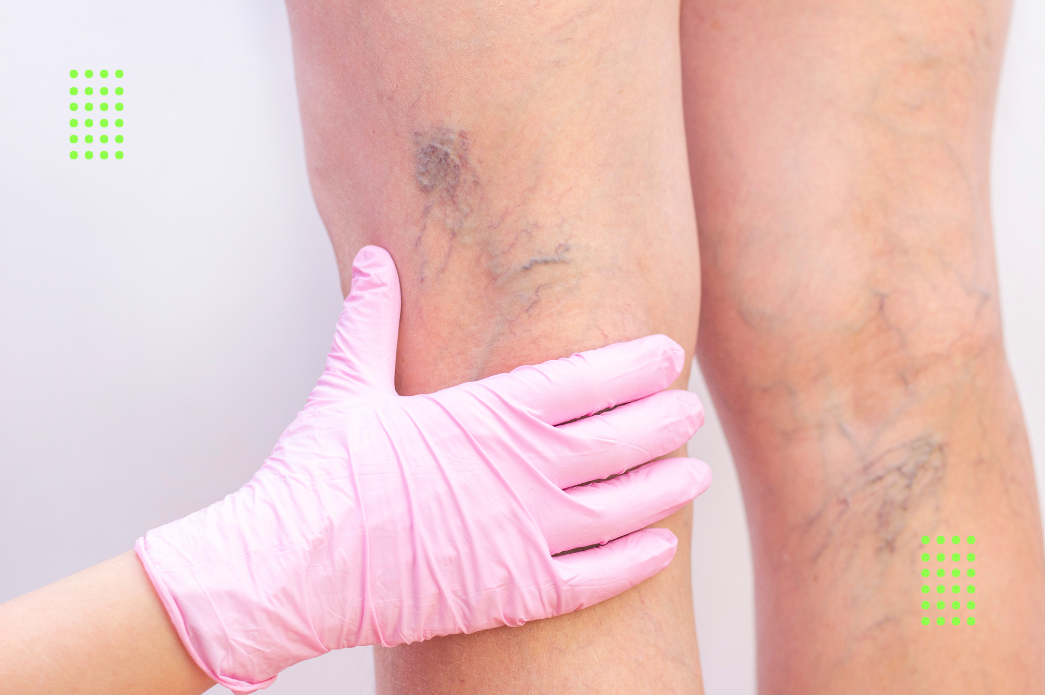 Varizes: quais exercícios ajudam na circulação e quais você deve evitar